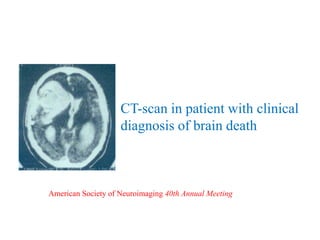 CT-scan in patient with clinical
diagnosis of brain death
American Society of Neuroimaging 40th Annual Meeting
 