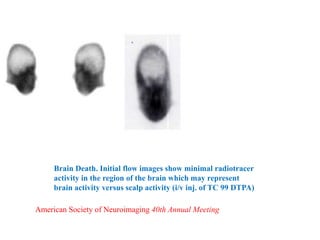 Brain Death. Initial flow images show minimal radiotracer
activity in the region of the brain which may represent
brain activity versus scalp activity (i/v inj. of TC 99 DTPA)
American Society of Neuroimaging 40th Annual Meeting
 