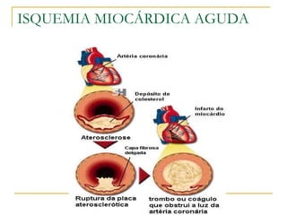 ISQUEMIA MIOCÁRDICA AGUDA 