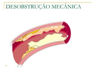 DESOBSTRUÇÃO MECÂNICA 
