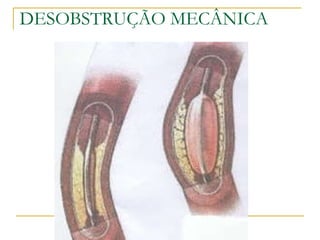 DESOBSTRUÇÃO MECÂNICA 
