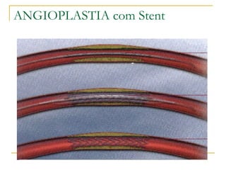 ANGIOPLASTIA com Stent 