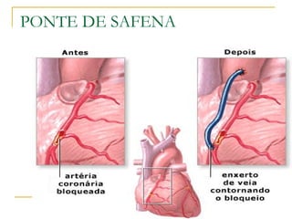 PONTE DE SAFENA 