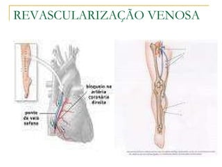 REVASCULARIZAÇÃO VENOSA 