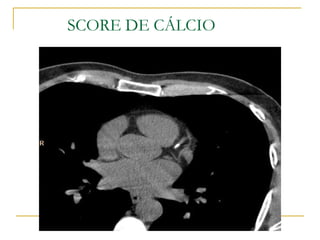 SCORE DE CÁLCIO 