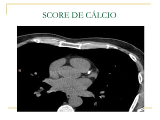 SCORE DE CÁLCIO 