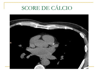 SCORE DE CÁLCIO 