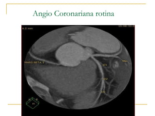 Angio Coronariana rotina 