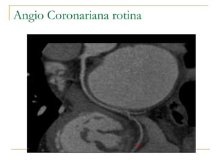 Angio Coronariana rotina 