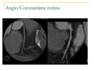 Angio Coronariana rotina 
