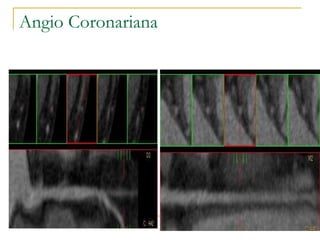 Angio Coronariana 