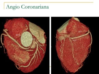 Angio Coronariana 