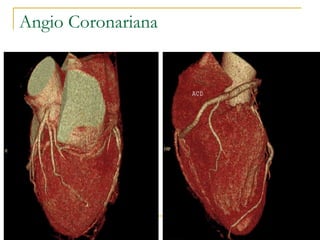 Angio Coronariana 