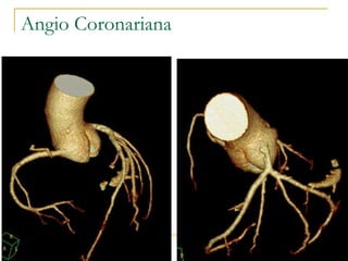 Angio Coronariana 