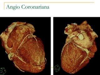 Angio Coronariana 