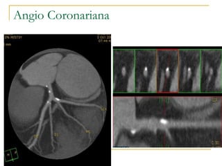 Angio Coronariana 