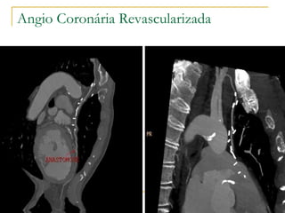 Angio Coronária Revascularizada 