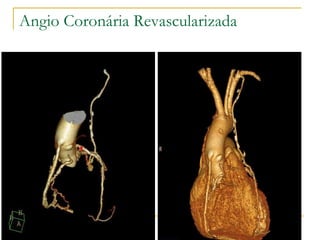 Angio Coronária Revascularizada 