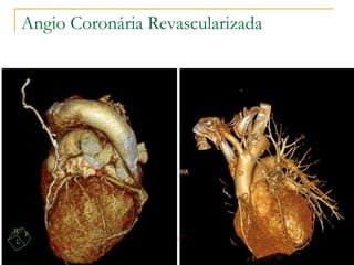 Angio Coronária Revascularizada 
