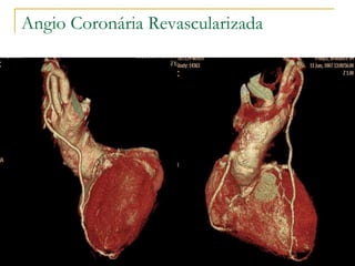 Angio Coronária Revascularizada 