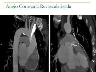 Angio Coronária Revascularizada 