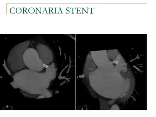CORONARIA STENT 