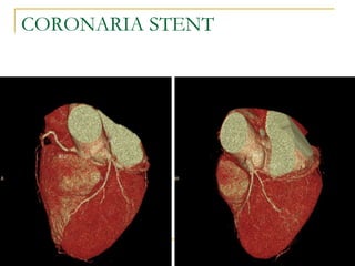 CORONARIA STENT 