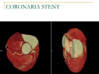 CORONARIA STENT 