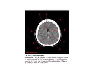 Tc de cranio