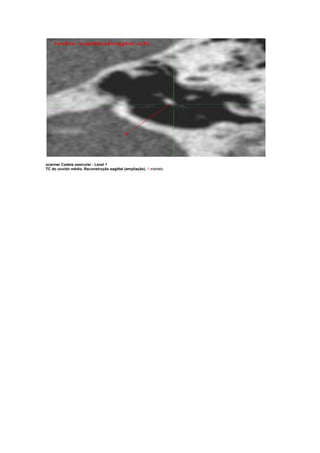 scanner Cadeia ossicular - Level 1
TC do ouvido médio, Reconstrução sagittal (ampliação). 1,martelo.
 