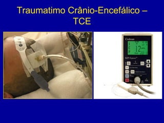 Traumatimo Crânio-Encefálico –
TCE
 