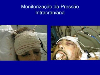Monitorização da Pressão
Intracraniana
 