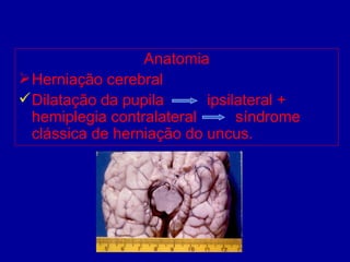 Anatomia
Herniação cerebral
Dilatação da pupila ipsilateral +
hemiplegia contralateral síndrome
clássica de herniação do uncus.
 