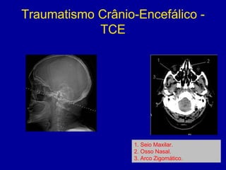 Traumatismo Crânio-Encefálico -
TCE
1. Seio Maxilar.
2. Osso Nasal.
3. Arco Zigomático.
 