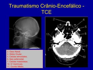 Traumatismo Crânio-Encefálico -
TCE
2. Osso Nasal.
4. Globo Ocular.
5. Celulas etmoidales.
6. Seio esfenoidal.
7. Celulas mastoideas.
10. IV Ventrículo.
11. Ouvido Médio.
 