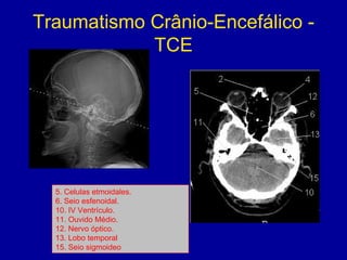 Traumatismo Crânio-Encefálico -
TCE
5. Celulas etmoidales.
6. Seio esfenoidal.
10. IV Ventrículo.
11. Ouvido Médio.
12. Nervo óptico.
13. Lobo temporal
15. Seio sigmoideo
 