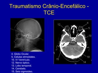 Traumatismo Crânio-Encefálico -
TCE
4. Globo Ocular.
5. Celulas etmoidales.
10. IV Ventrículo.
12. Nervo óptico.
13. Lobo temporal.
14. Cerebelo.
15. Seio sigmoideo.
 