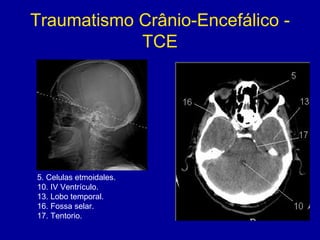 Traumatismo Crânio-Encefálico -
TCE
5. Celulas etmoidales.
10. IV Ventrículo.
13. Lobo temporal.
16. Fossa selar.
17. Tentorio.
 