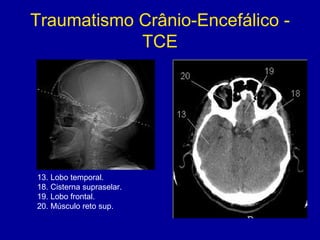 Traumatismo Crânio-Encefálico -
TCE
13. Lobo temporal.
18. Cisterna supraselar.
19. Lobo frontal.
20. Músculo reto sup.
 