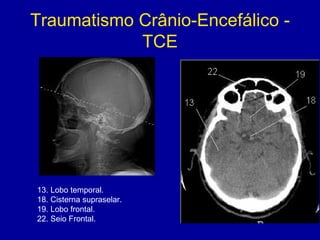 Traumatismo Crânio-Encefálico -
TCE
13. Lobo temporal.
18. Cisterna supraselar.
19. Lobo frontal.
22. Seio Frontal.
 