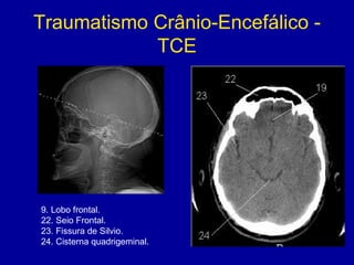 Traumatismo Crânio-Encefálico -
TCE
9. Lobo frontal.
22. Seio Frontal.
23. Fissura de Silvio.
24. Cisterna quadrigeminal.
 