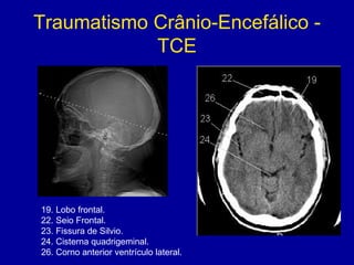Traumatismo Crânio-Encefálico -
TCE
19. Lobo frontal.
22. Seio Frontal.
23. Fissura de Silvio.
24. Cisterna quadrigeminal.
26. Corno anterior ventrículo lateral.
 