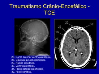 Traumatismo Crânio-Encefálico -
TCE
26. Corno anterior ventrículo lateral.
28. Glândula pineal calcificada.
29. Núcleo Caudado.
30. Ventrículo lateral.
31. Plexo coroide calcificado.
32. Foice cerebral.
 
