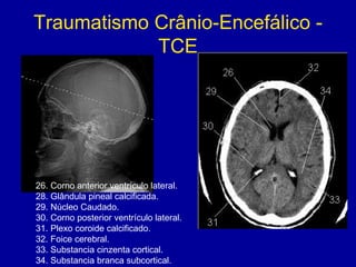 Traumatismo Crânio-Encefálico -
TCE
26. Corno anterior ventrículo lateral.
28. Glândula pineal calcificada.
29. Núcleo Caudado.
30. Corno posterior ventrículo lateral.
31. Plexo coroide calcificado.
32. Foice cerebral.
33. Substancia cinzenta cortical.
34. Substancia branca subcortical.
 
