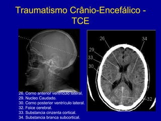 Traumatismo Crânio-Encefálico -
TCE
26. Corno anterior ventrículo lateral.
29. Nucleo Caudado.
30. Corno posterior ventrículo lateral.
32. Foice cerebral.
33. Substancia cinzenta cortical.
34. Substancia branca subcortical.
 