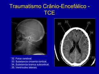 Traumatismo Crânio-Encefálico -
TCE
32. Foice cerebral.
33. Substancia cinzenta cortical.
34. Substancia branca subcortical.
35. Ventrículos laterais.
 