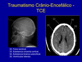 Traumatismo Crânio-Encefálico -
TCE
32. Foice cerebral.
33. Substancia cinzenta cortical.
34. Substancia branca subcortical.
35. Ventrículos laterais.
 