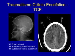 Traumatismo Crânio-Encefálico -
TCE
32. Foice cerebral.
33. Substancia cinzenta cortical.
34. Substancia branca subcortical.
 