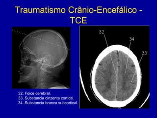 Traumatismo Crânio-Encefálico -
TCE
32. Foice cerebral.
33. Substancia cinzenta cortical.
34. Substancia branca subcortical.
 
