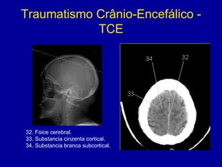 Traumatismo Crânio-Encefálico -
TCE
32. Foice cerebral.
33. Substancia cinzenta cortical.
34. Substancia branca subcortical.
 